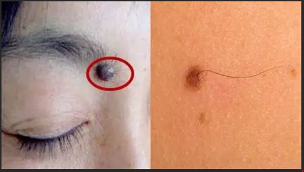 Tahi Lalat: Bukan Sekadar Penampilan, Tapi Juga Indikator Kesehatan Kulit