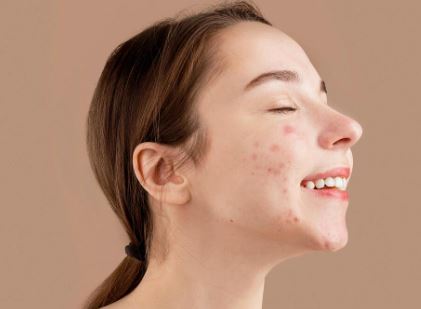Kecantikan : Acne Positivity -  Gerakan Mencintai Kulit Berjerawat dan Bangkitkan Rasa Percaya Diri